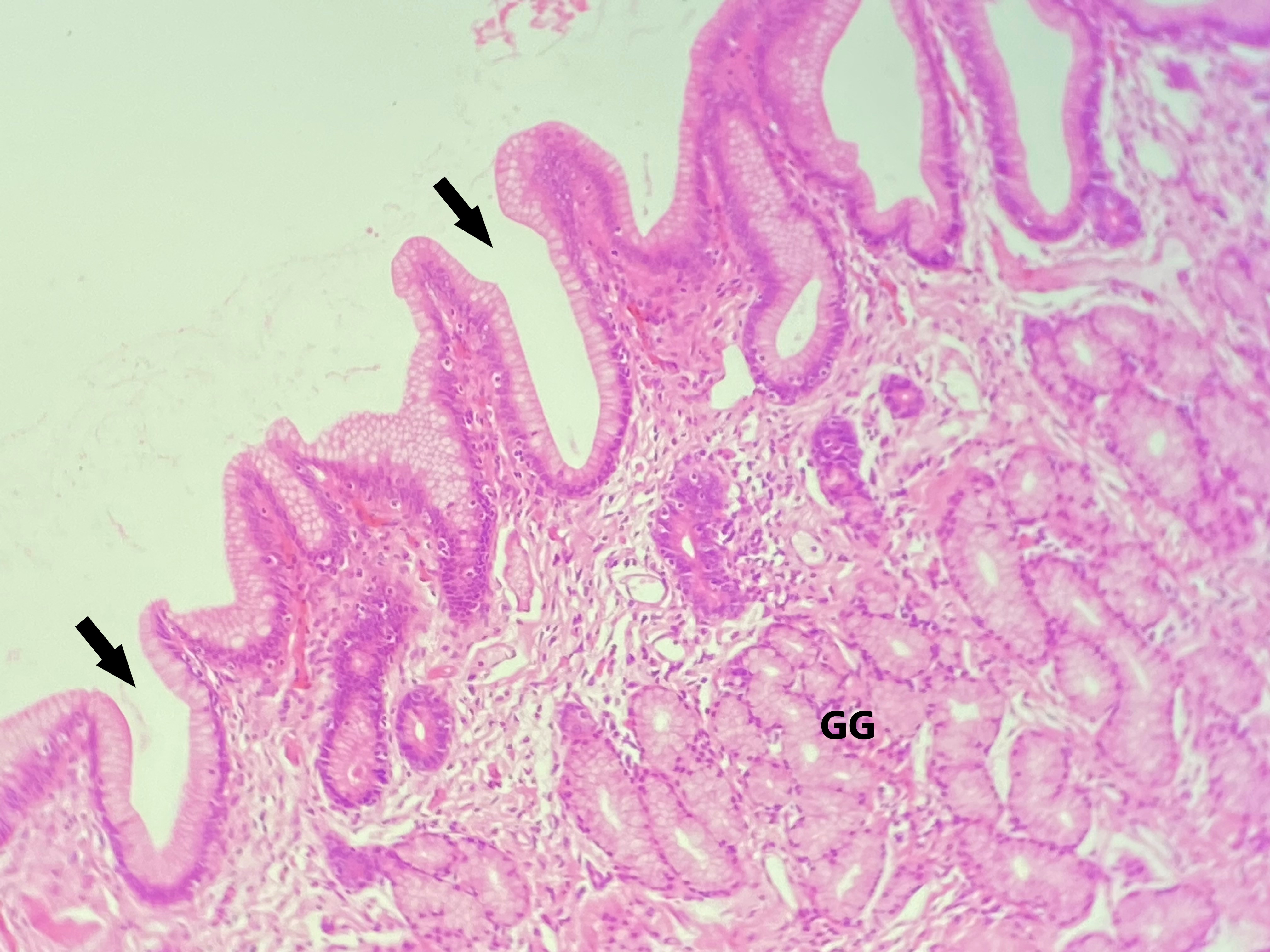 Lâmina: Estômago (H&E - Aumento: 200x). A fotomicrografia exibe um corte do estômago, revestido internamente por um epitélio simples colunar. As setas apontam para as fossetas gástricas e é possível observar parte das glândulas gástricas (GG) na mucosa.