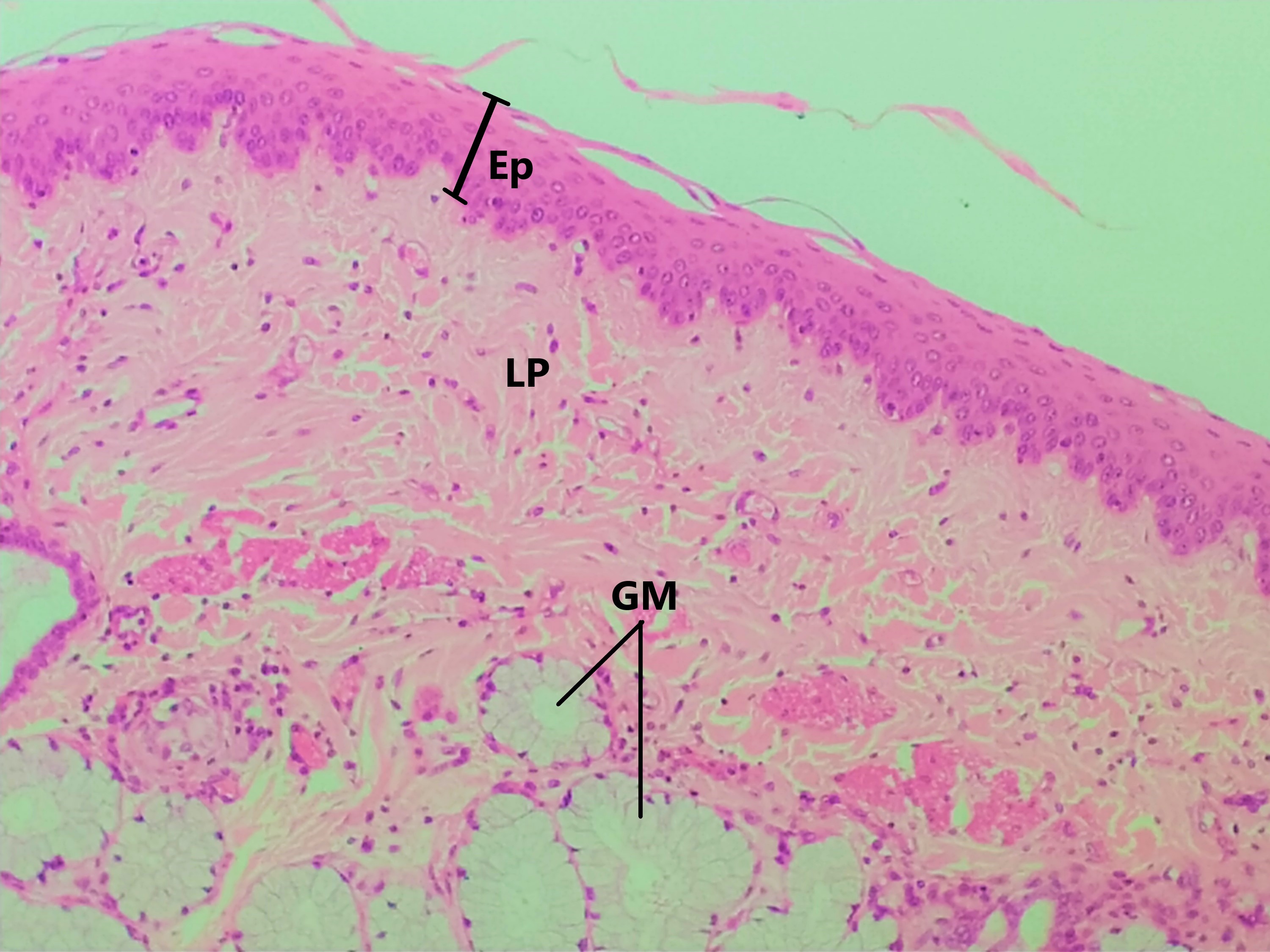Lâmina: Esôfago (H&E - Aumento: 200x). O esôfago é revestido pelo epitélio estratificado pavimentoso não queratinizado. Possui várias camadas celulares, que variam de formato desde a camada basal até a superfície apical do epitélio, um processo de migração ascendente e diferenciação celular.  Em menor aumento, é possível observar a lâmina própria (LP) (tecido conjuntivo) subjacente e glândulas mucosas (GM), cuja secreção lubrifica e protege a superfície epitelial, não sendo necessária queratinização (camada córnea) neste local.