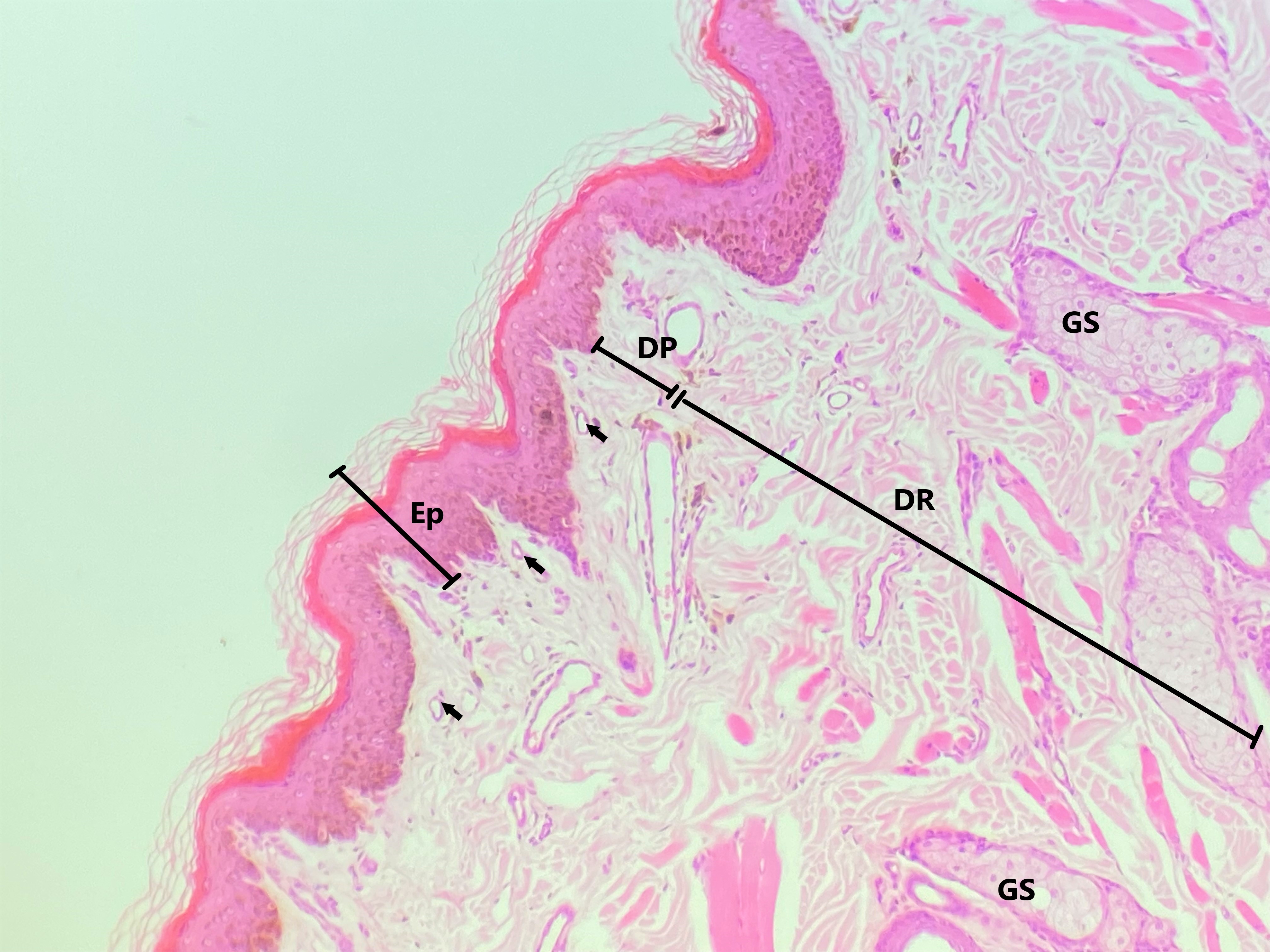 Lâmina: Pele fina (H&E - Aumento: 200x).  Epitélio estratificado pavimentoso queratinizado da pele delgada (Pequeno aumento). É possível observar as camadas da pele, a epiderme (Ep) e a derme (De). A derme pode ser subdividida em derme papilar (DP), constituída por tecido conjuntivo frouxo apresentando vários capilares sanguíneos (CS), e em derme reticular (DR), formada por tecido conjuntivo denso não modelado.