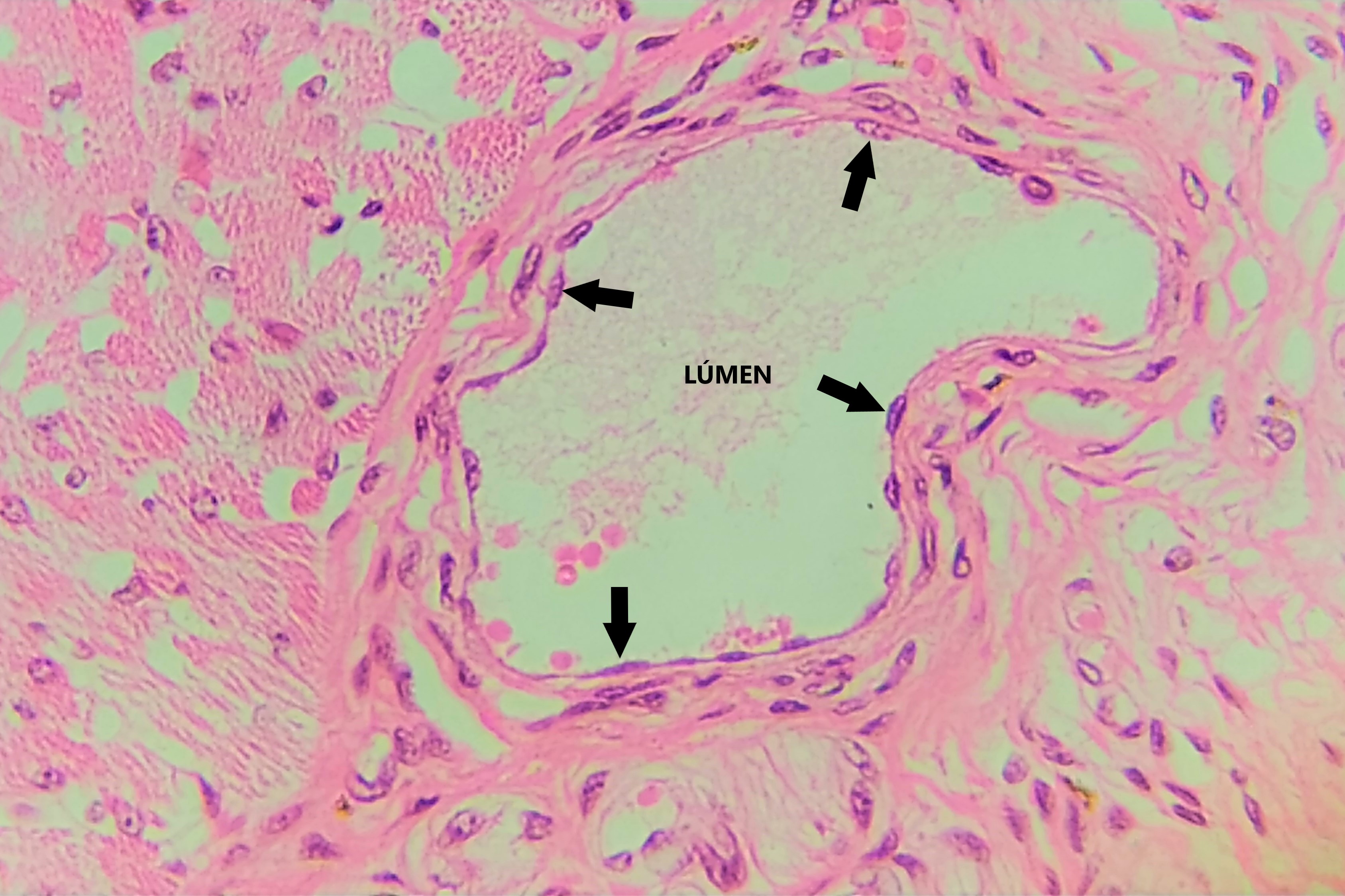 Lâmina: Pele - vaso sanguíneo (H&E - Aumento: 400x). A fotomicrografia mostra um vaso sanguíneo cortado transversalmente, revestido internamente por epitélio simples pavimentoso, conhecido como endotélio.  As setas apontam para os núcleos das células pavimentosas, que fazem saliência no lúmen ou luz do vaso.   É possível observar uma fileira única de células, identificadas por seus núcleos achatados (acompanhando o formato das células).